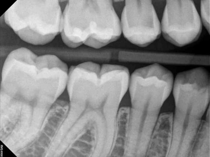 Intraoral technique of exposing periapical and bitewing images