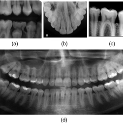 Intraoral technique of exposing periapical and bitewing images