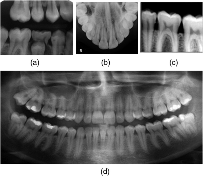 Intraoral technique of exposing periapical and bitewing images