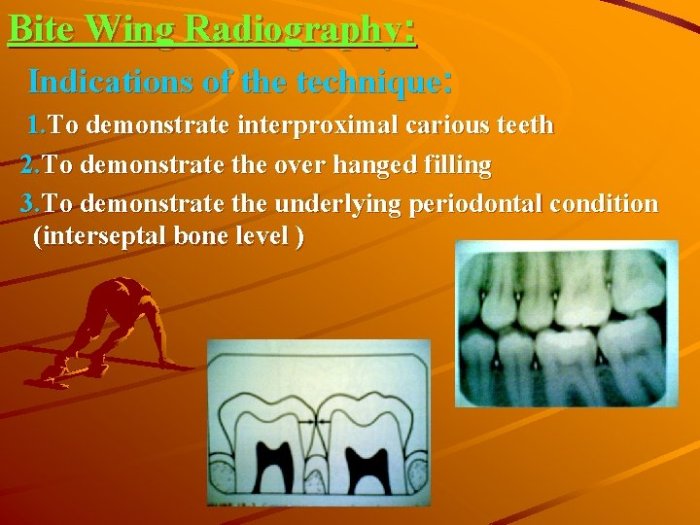 Bitewing radiograph hygiene dentistry